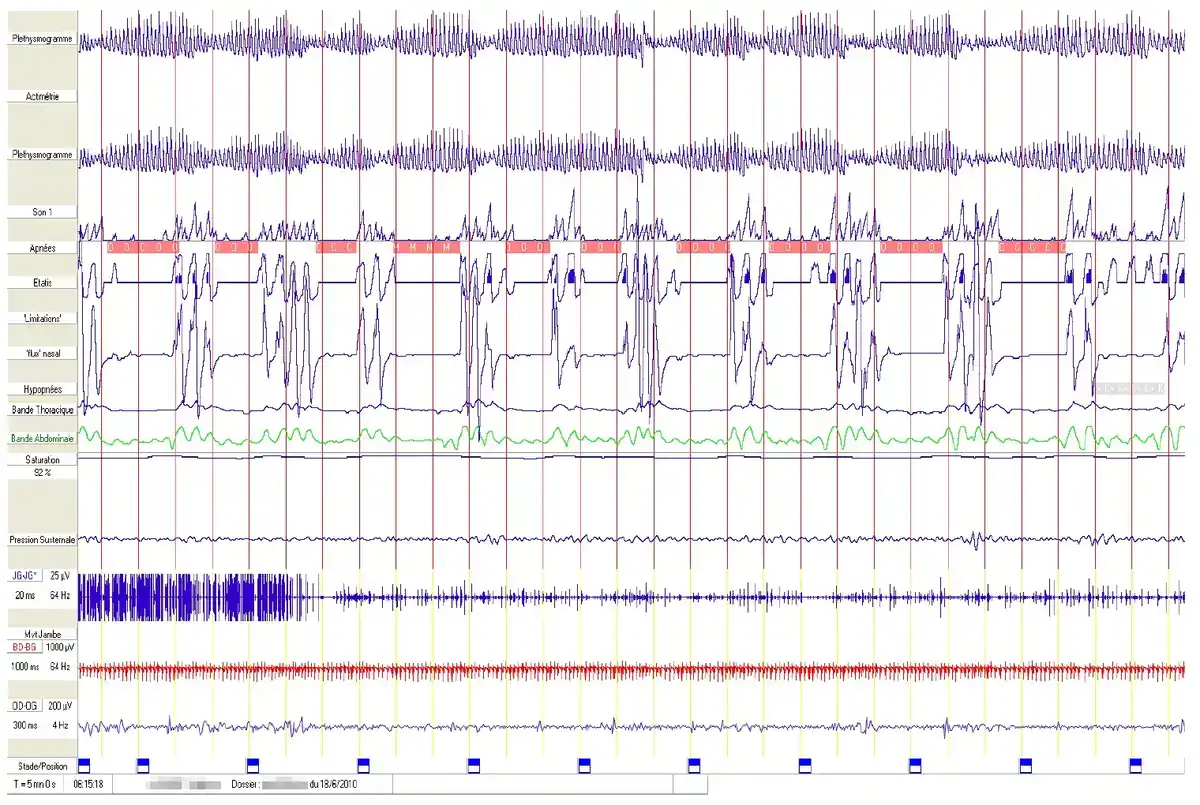 Polysomnographie